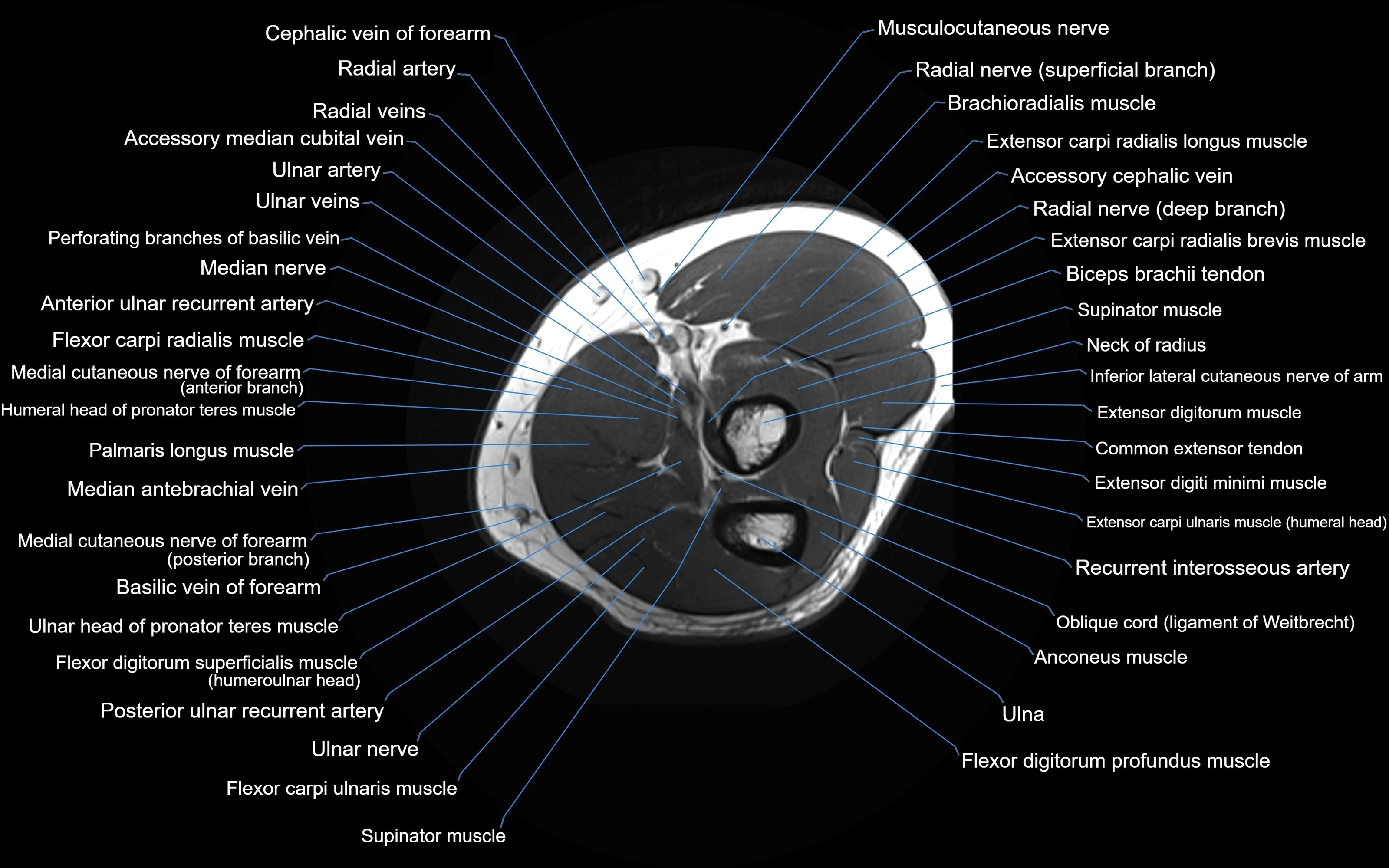 MRI elbow axial cross sectional anatomy 3T  radiology  image-img-00001-00024.webp